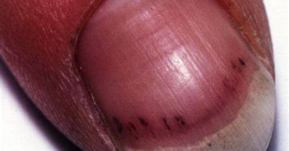 Can Splinter Hemorrhages Be Benign?