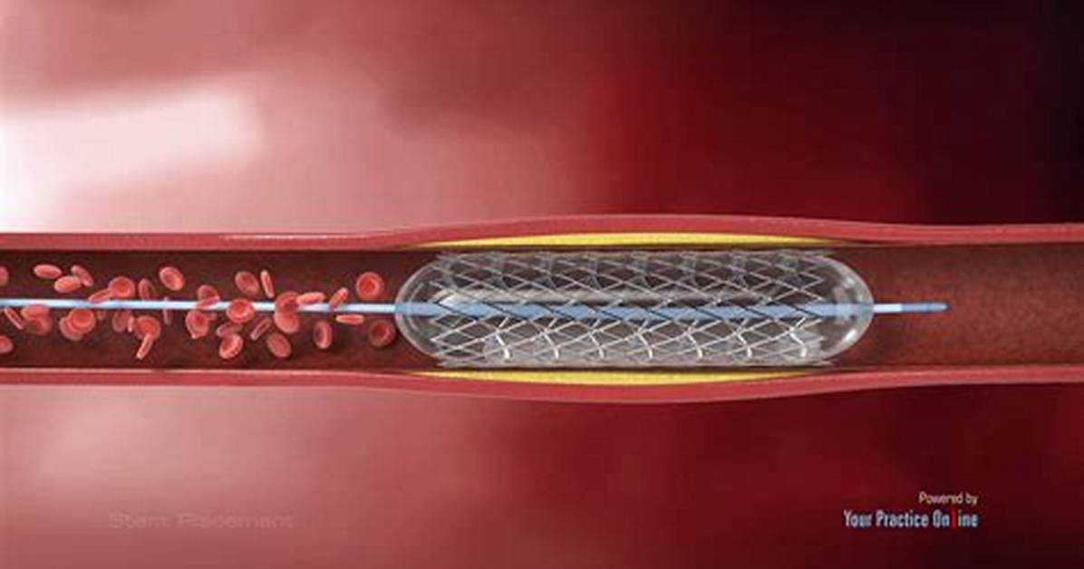 Can Stent Be Plural?