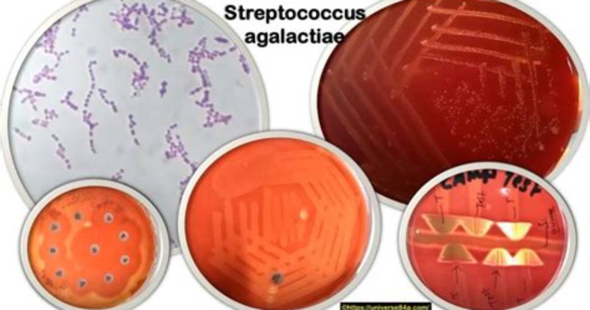 Can Streptococcus Agalactiae Be Cured?