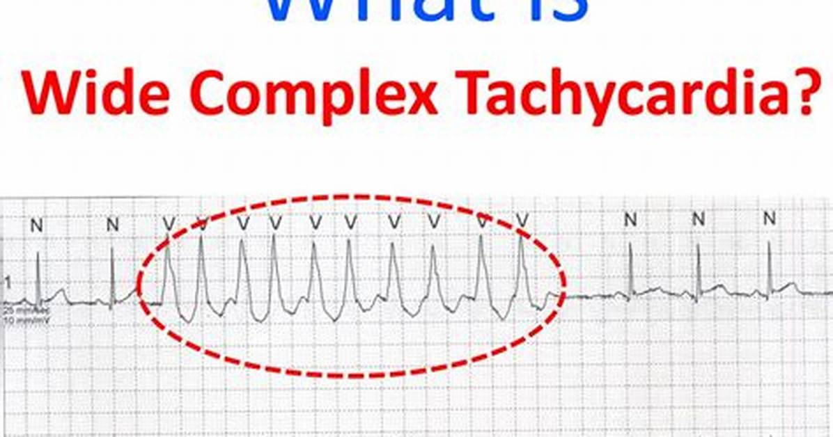 Can Svt Be Wide Complex