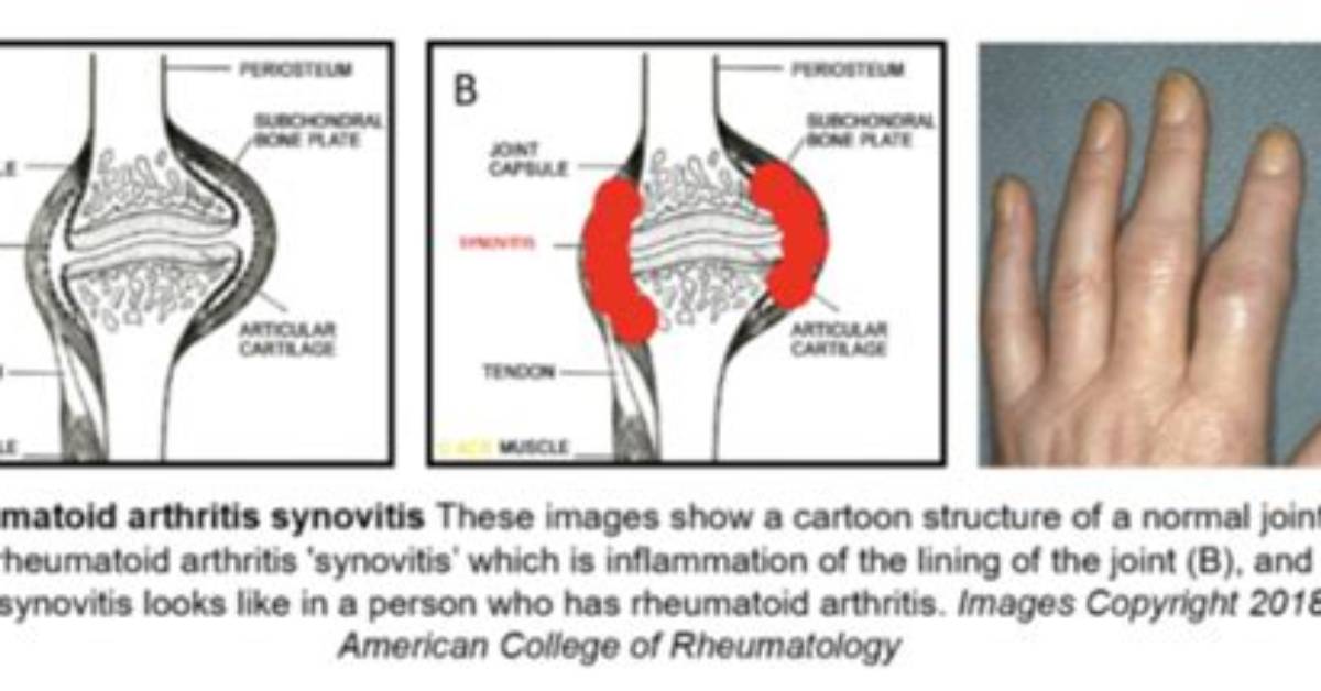 Can Synovitis Be Cured?