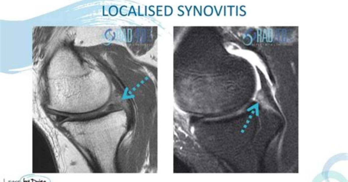 Can Synovitis Be Seen on Xray?