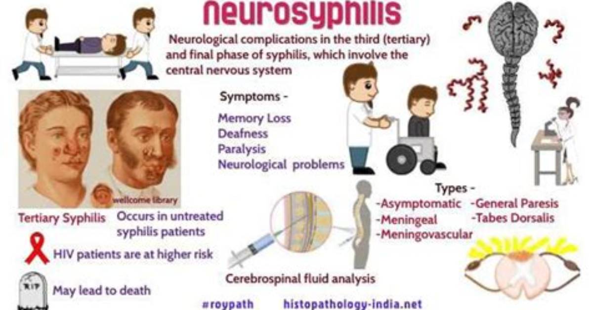 Can Syphilis Affect Nerves