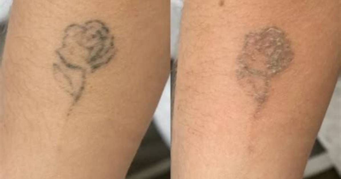 Can Tattoos Be Removed?