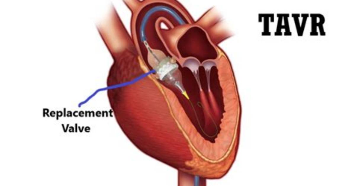 Can Tavr Be Repeated?