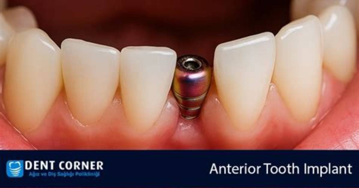 Can Teeth Be Implanted?