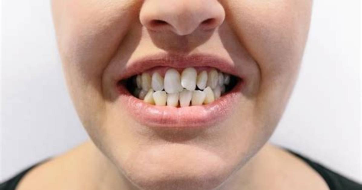 Can Teeth Be Levelled?