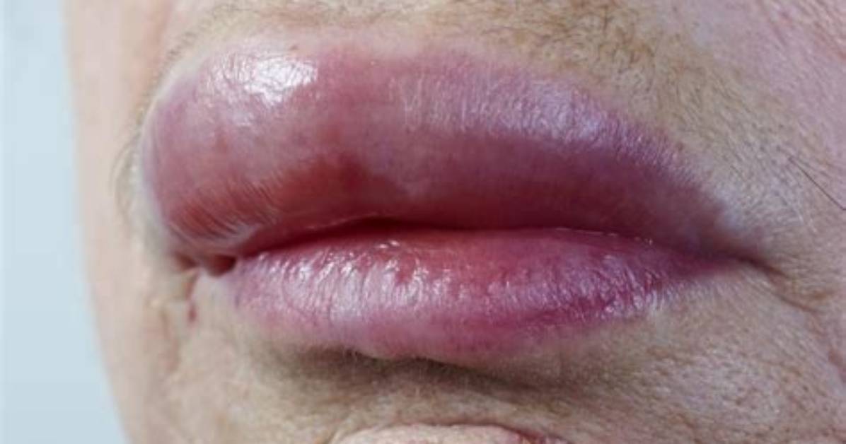Can Thyroid Cause Swollen Lips?