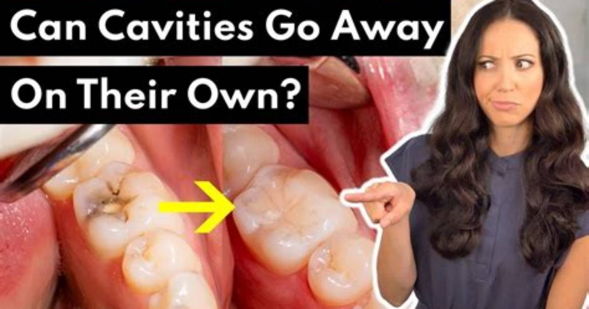 Can Tiny Cavities Go Away?