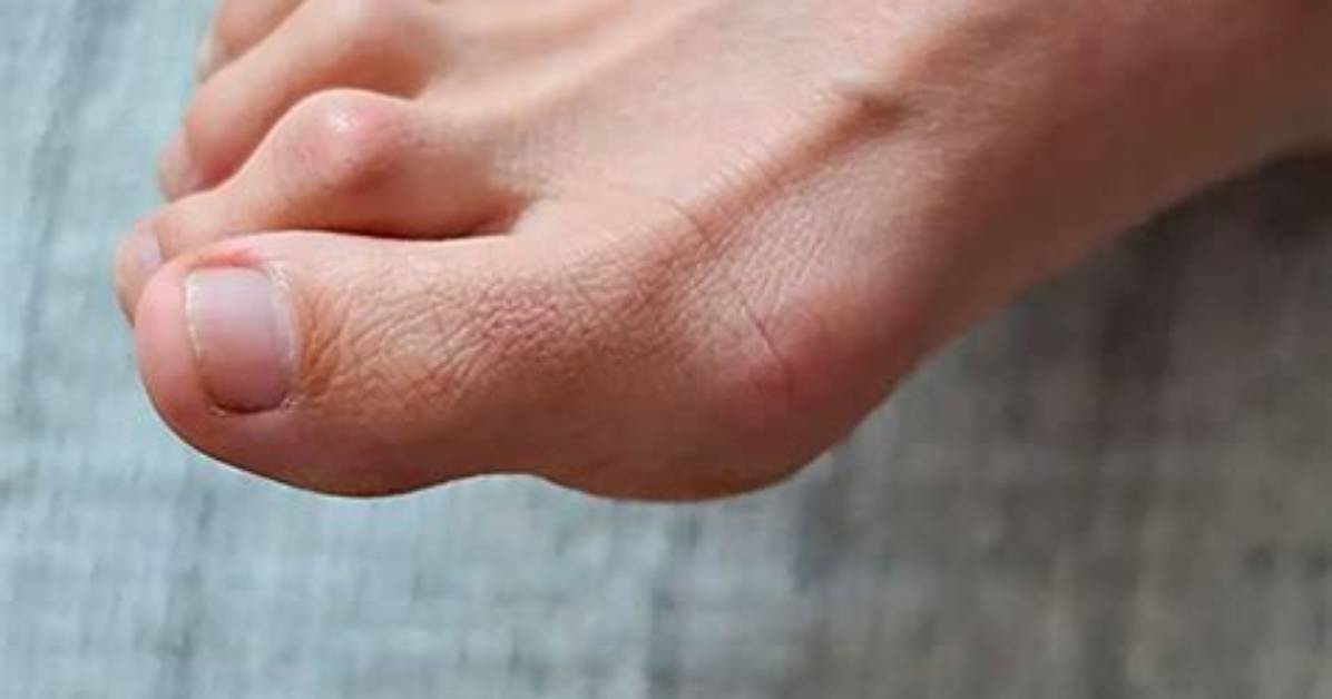 Can Toes Be Realigned