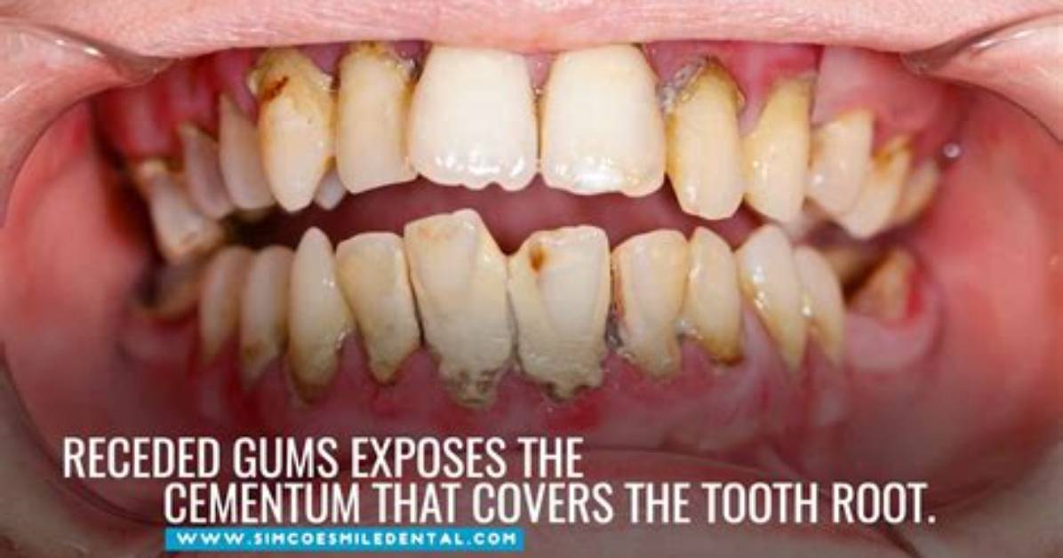 Can Tooth Brushing Damage Teeth?
