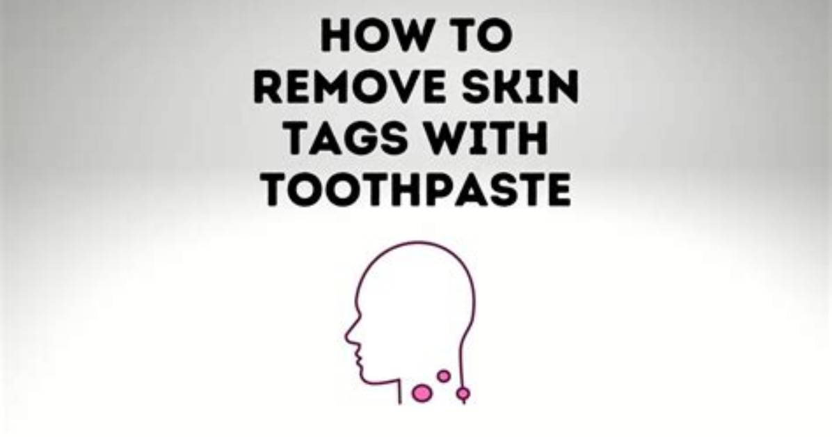 Can Toothpaste Really Remove Skin Tags?