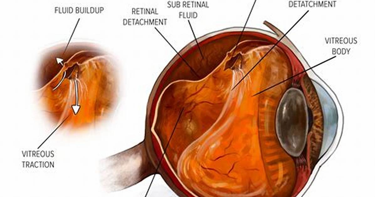Can Trauma Cause Retinal Detachment?