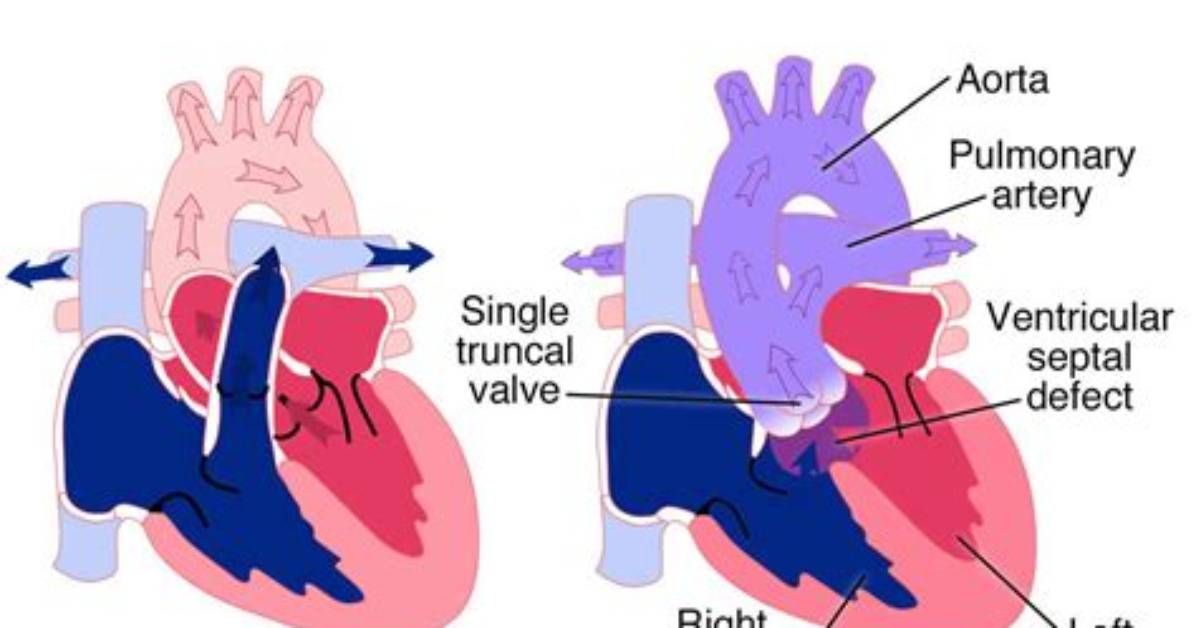Can Truncus Arteriosus Be Cured?