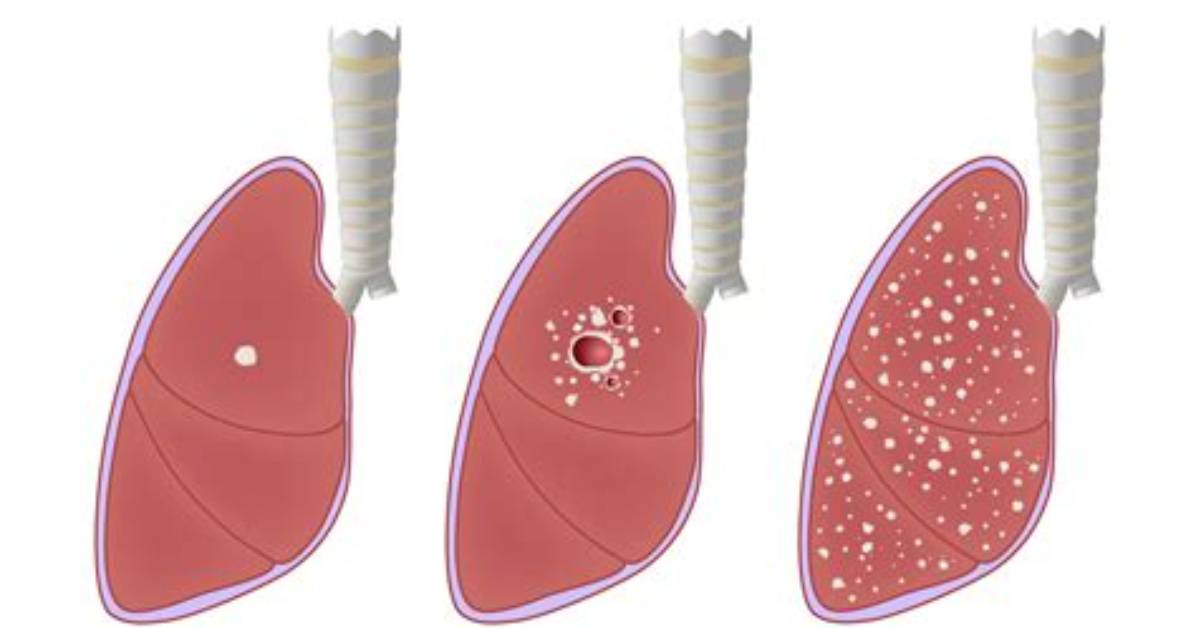 Can Tuberculosis Kill You?