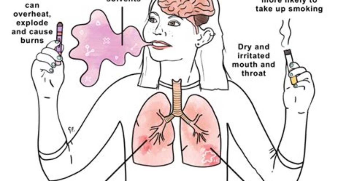 Can Vaping Cause Esophagitis?