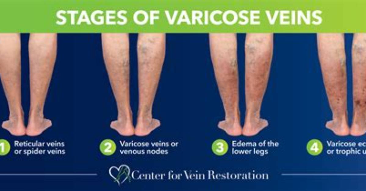 Can Veins Get Twisted?