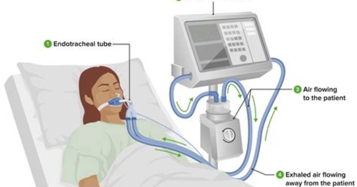 Can Ventilator Be Removed?