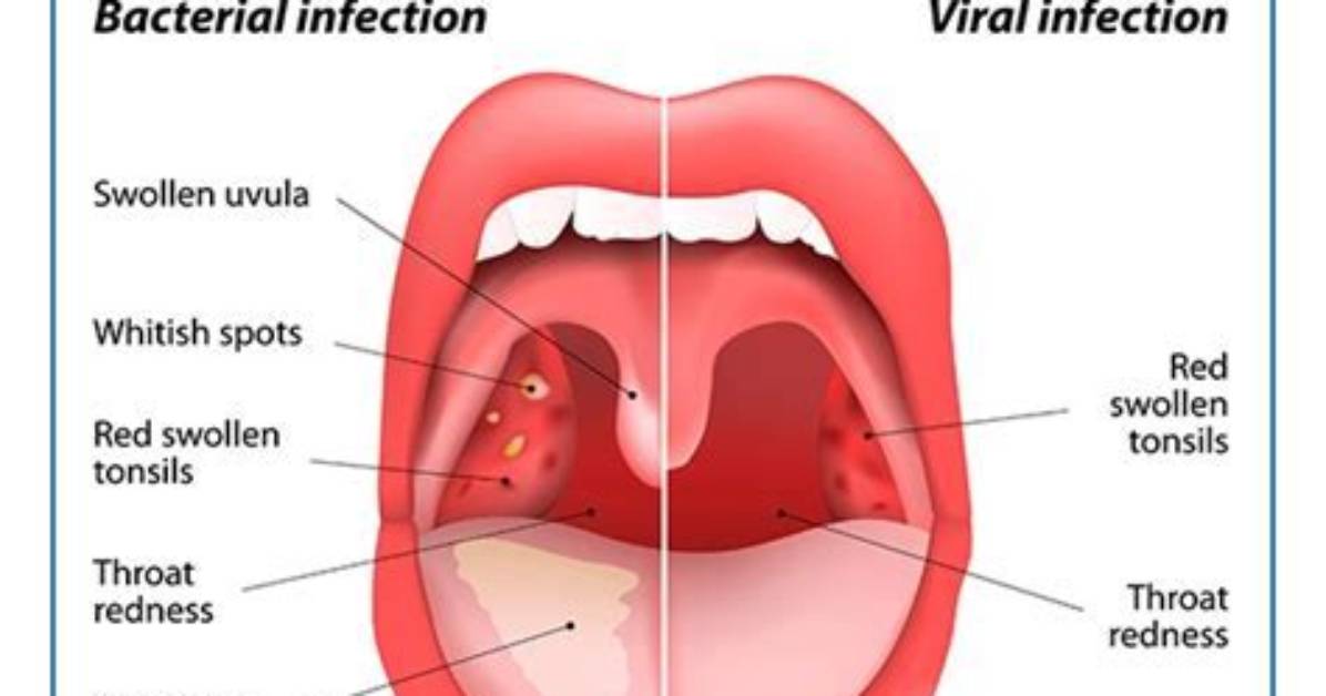 Can Virtual Doctors Diagnose Strep Throat?