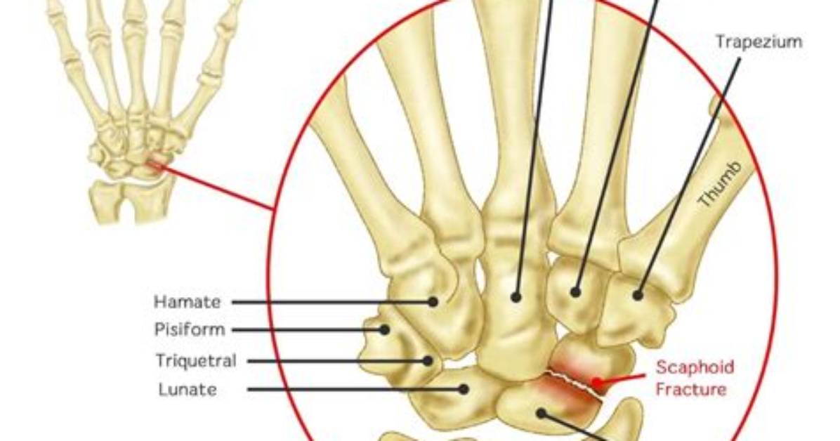 Can You Dislocate a Carpal Bone