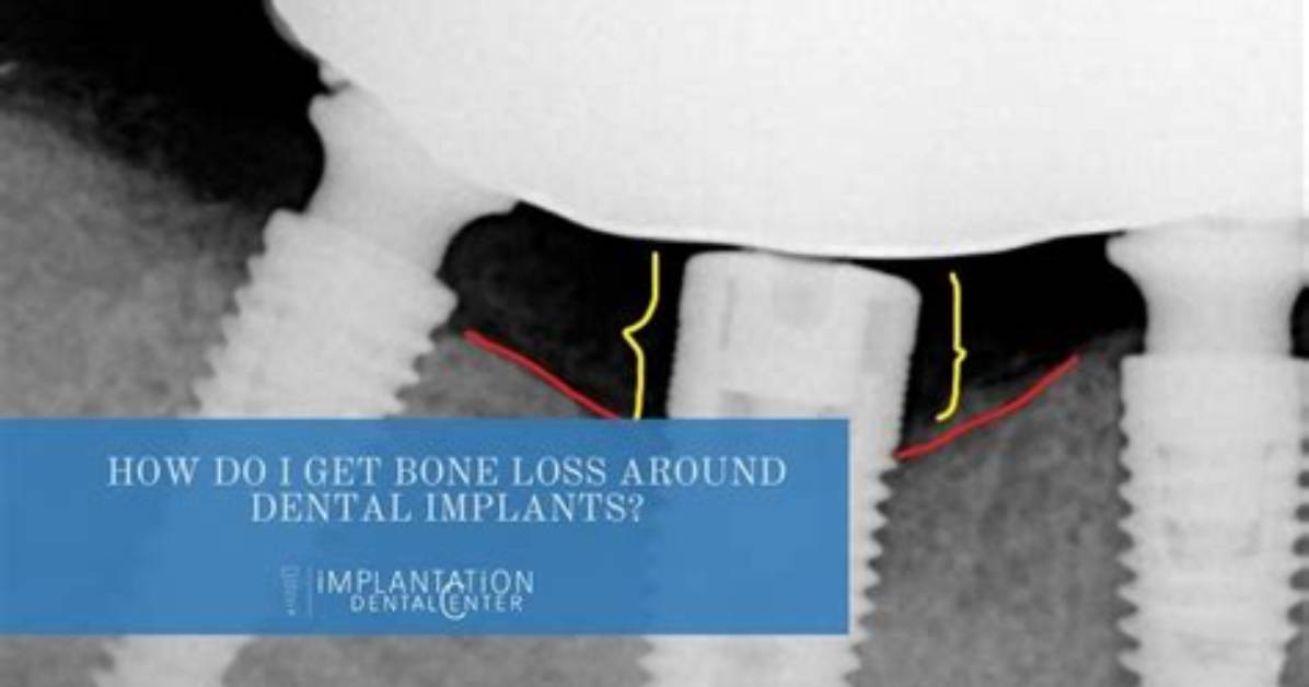Can You Get Implants with Bone Loss?