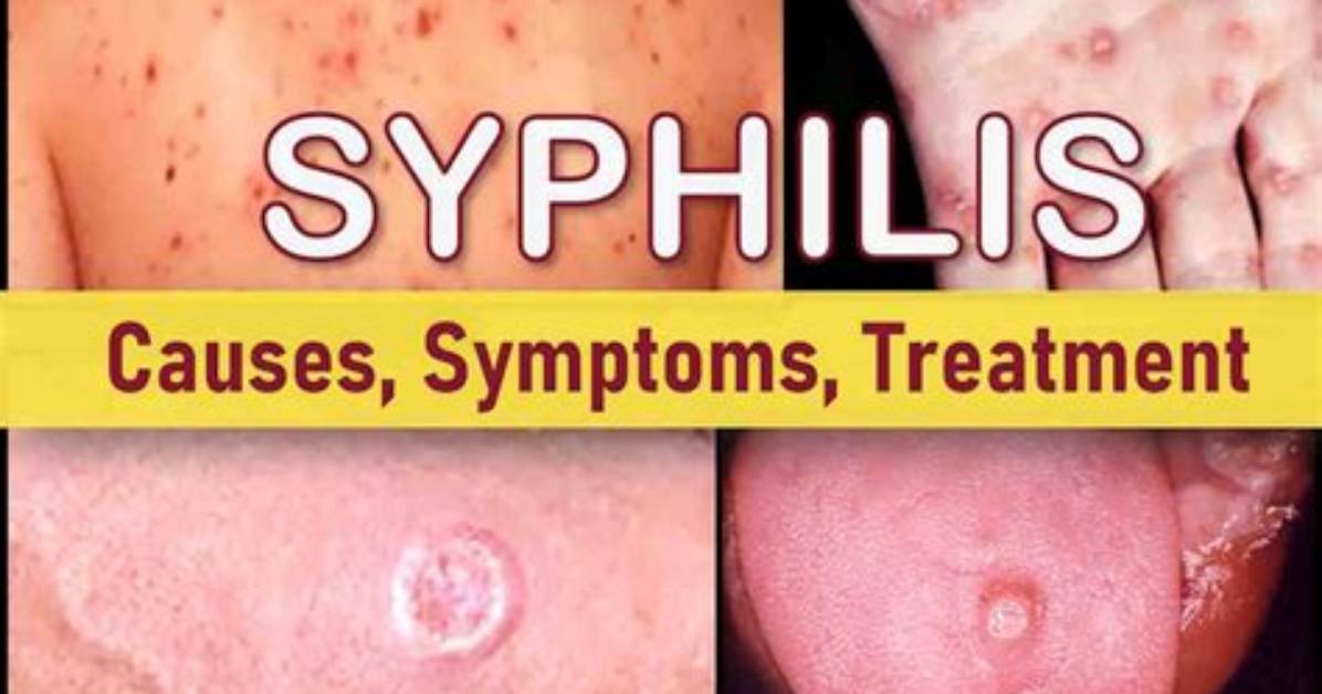 Can You Get Syphilis?