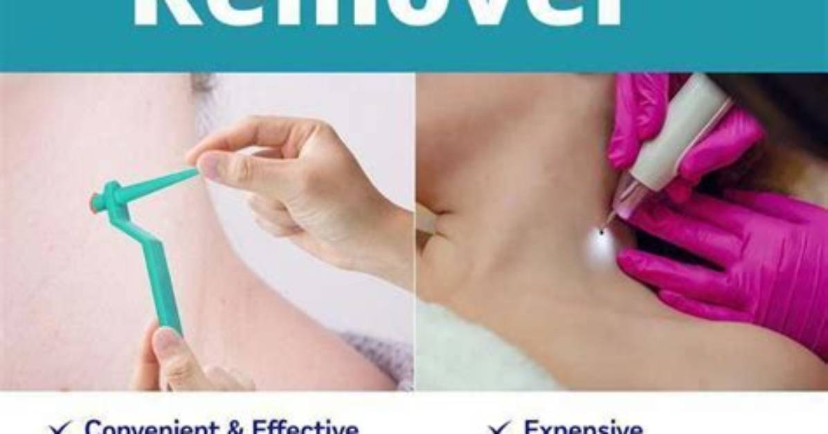 Can You Remove Skin Divers?
