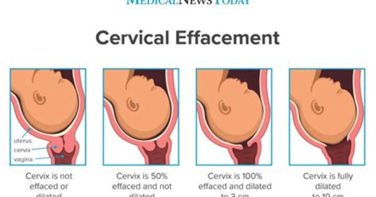 Can Your Cervix Uneffaced?