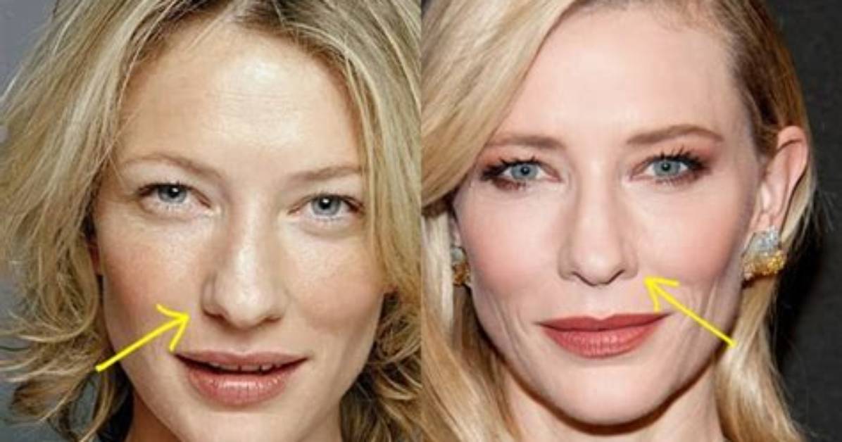 Cate Blanchett Facelift Plastic Surgery Before and After