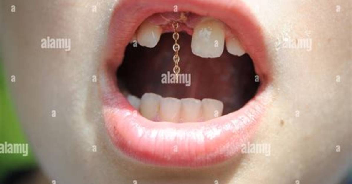 Chain on Tooth to Pull It Down