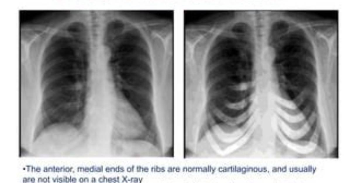 Costochondral Calcification