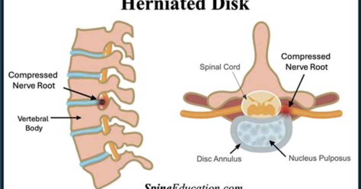 Could a Herniated Disc Cause Dizziness?