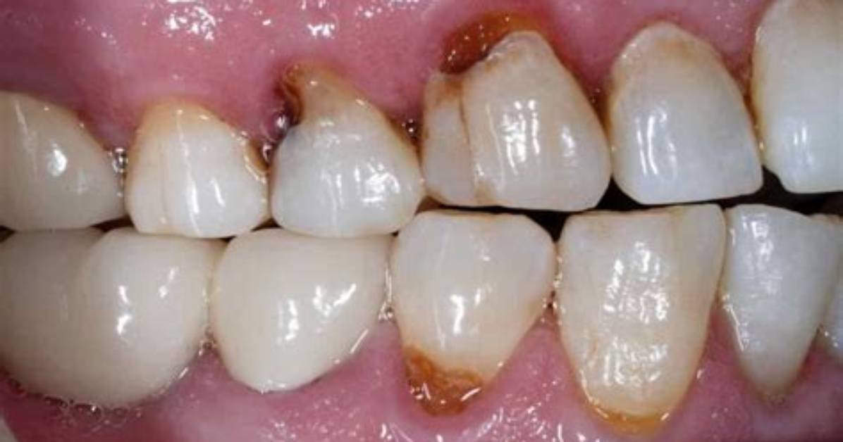 Could a Rotten Tooth Kill You?