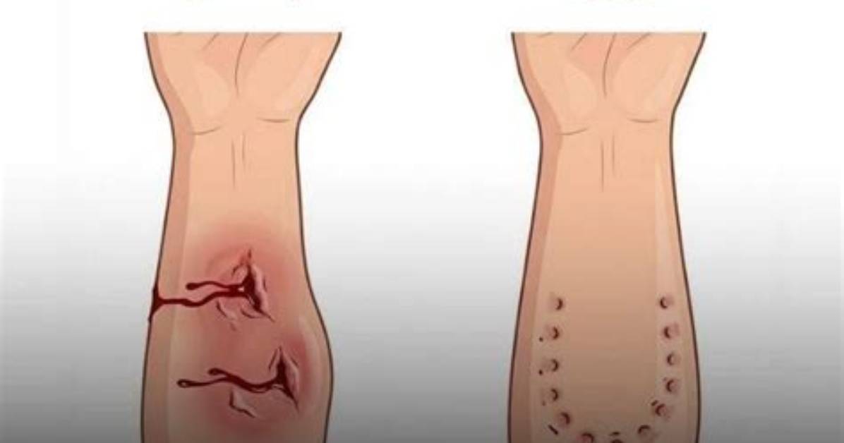 Could Be Bitten by a Snake?