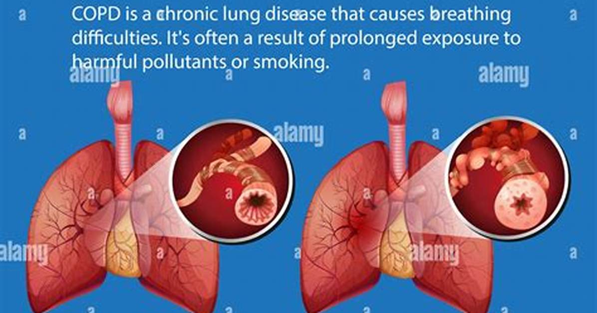 Could Chronic Obstructive Pulmonary Disease?
