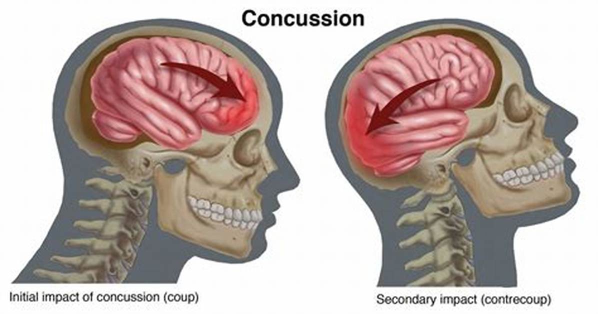 Could Concussions Cause Vertigo?