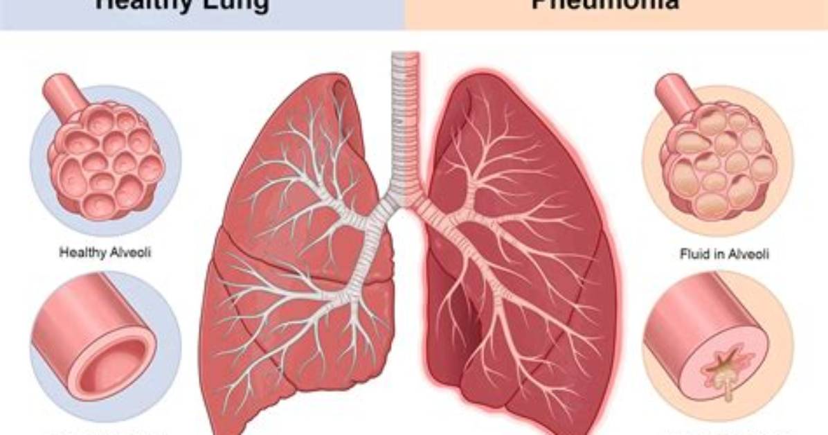 Could Damp Cause Pneumonia?