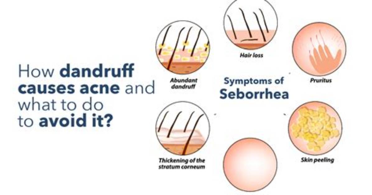 Could Dandruff Cause Acne?