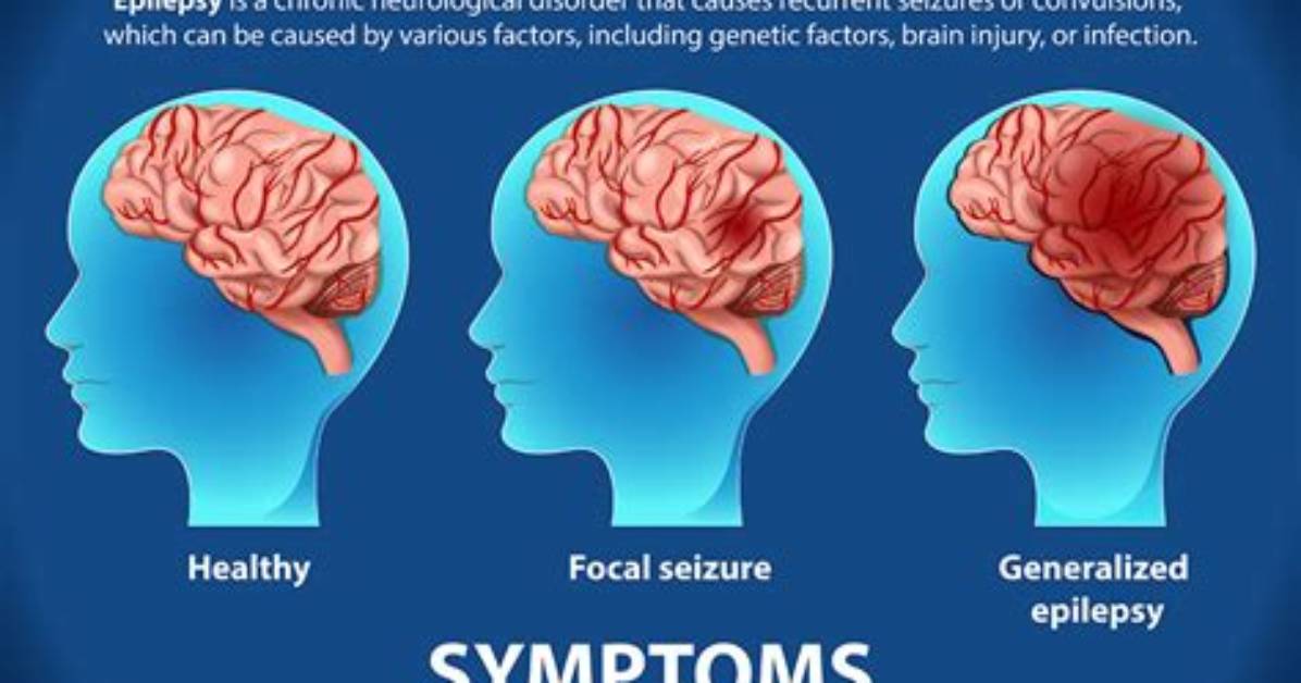 Could Epilepsy Kill You?
