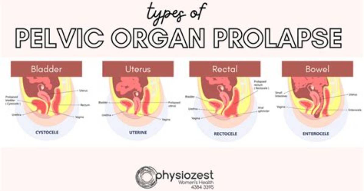 Could I Have a Prolapse?
