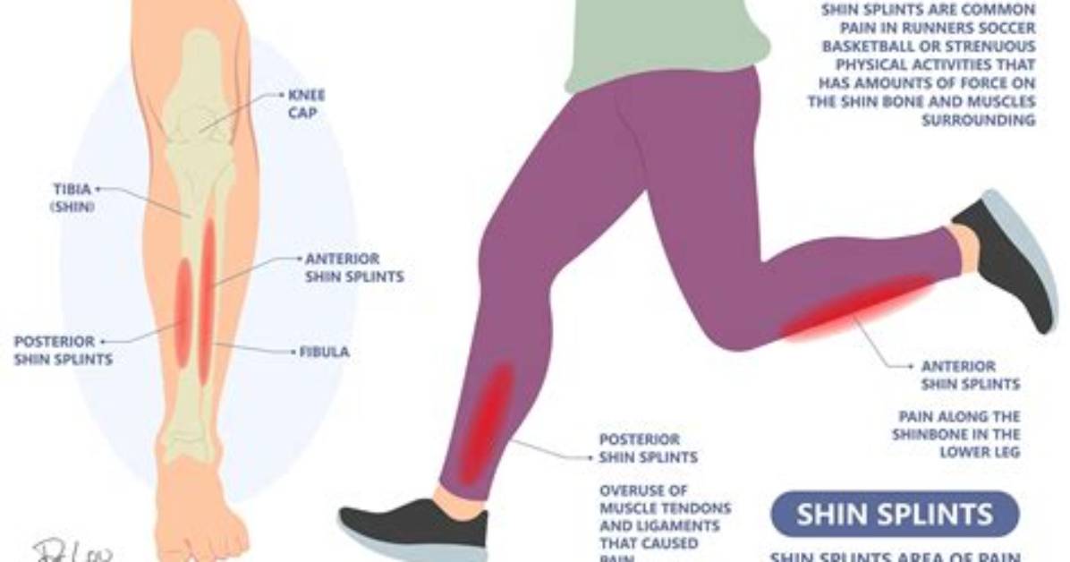 Could My Shoes Be Causing Shin Splints?