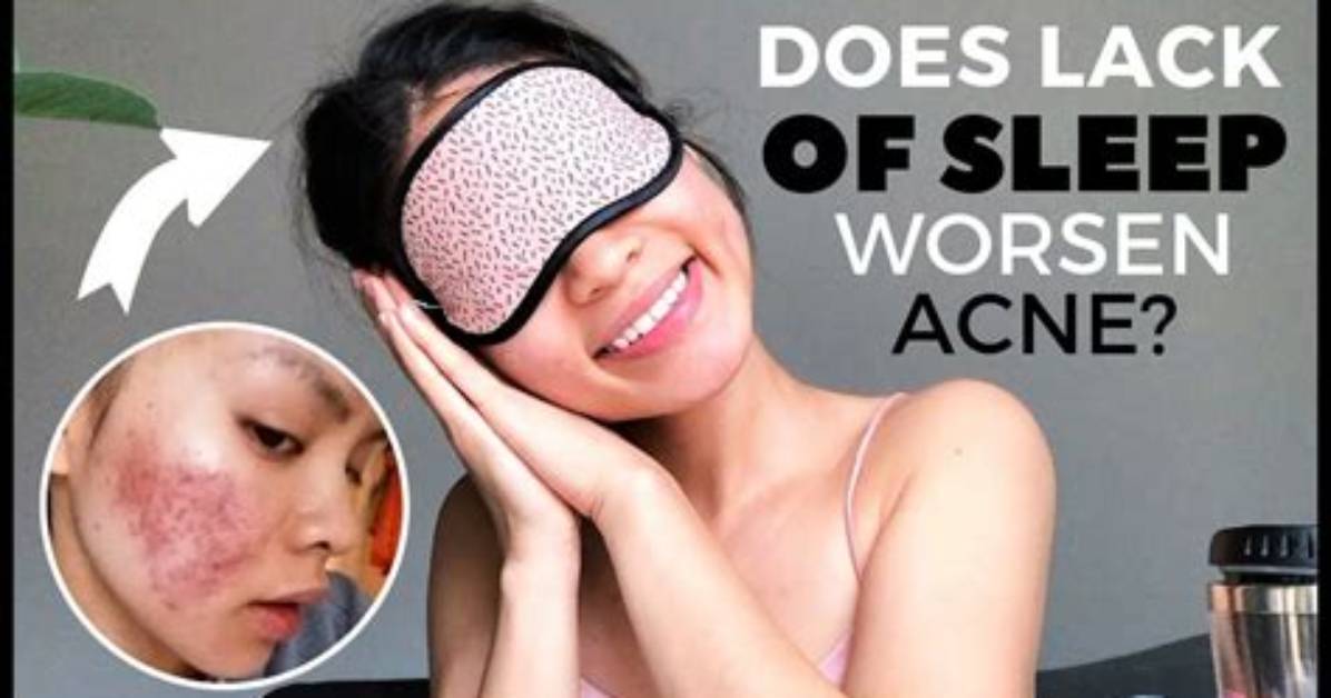 Could Sleep Be Causing My Acne?