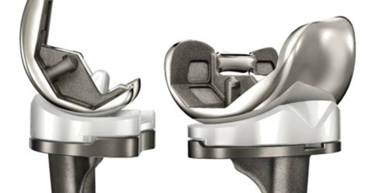 Custom Total Knee Replacement |