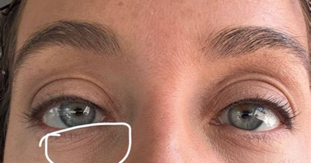 Definitions of Dull Eyes - Onelook