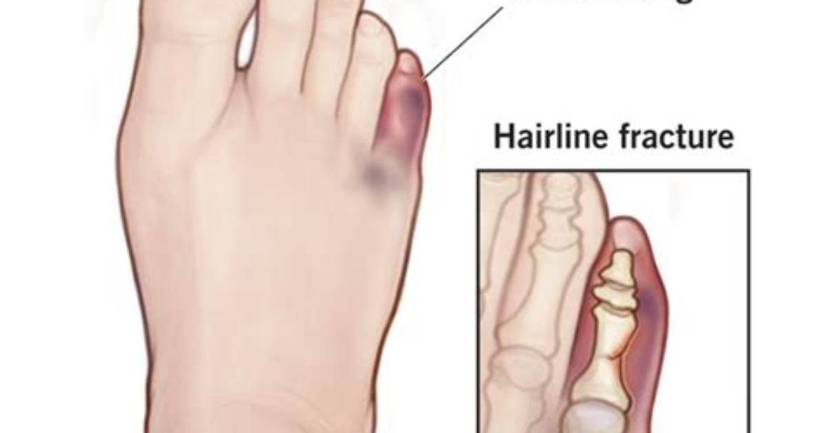 Did Break My Toe?