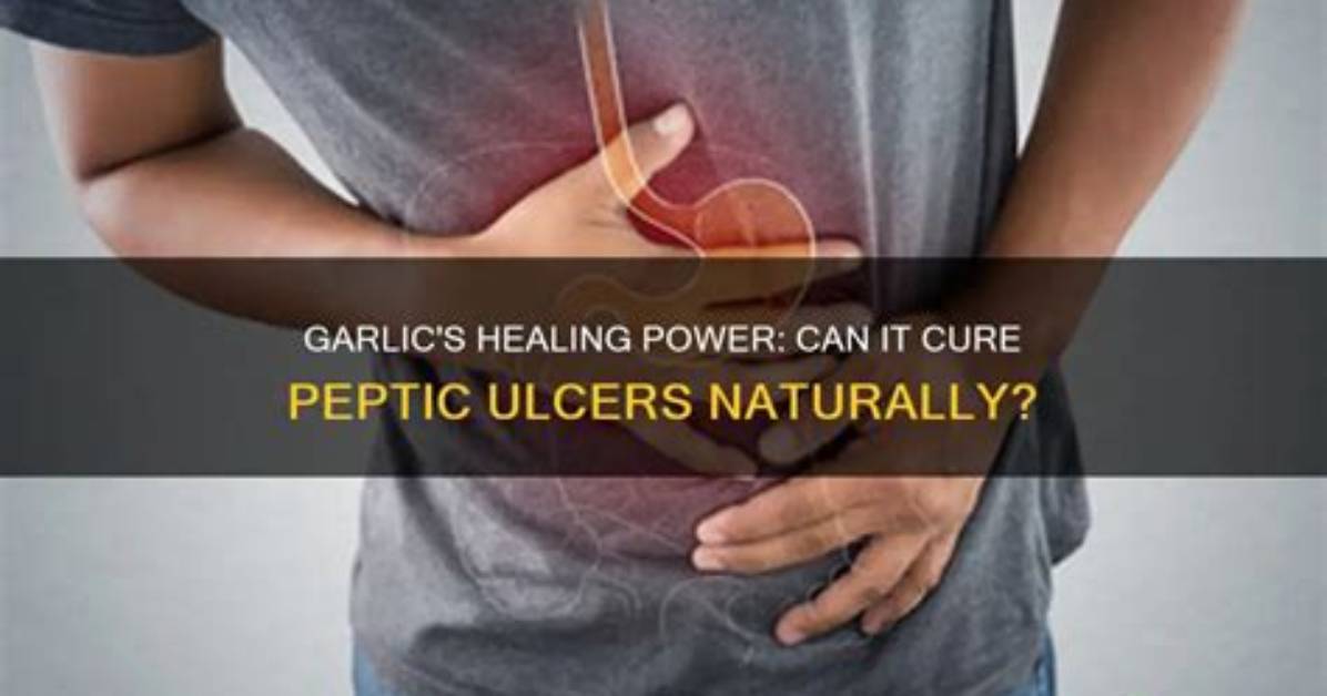 Did Garlic Cure Ulcer?