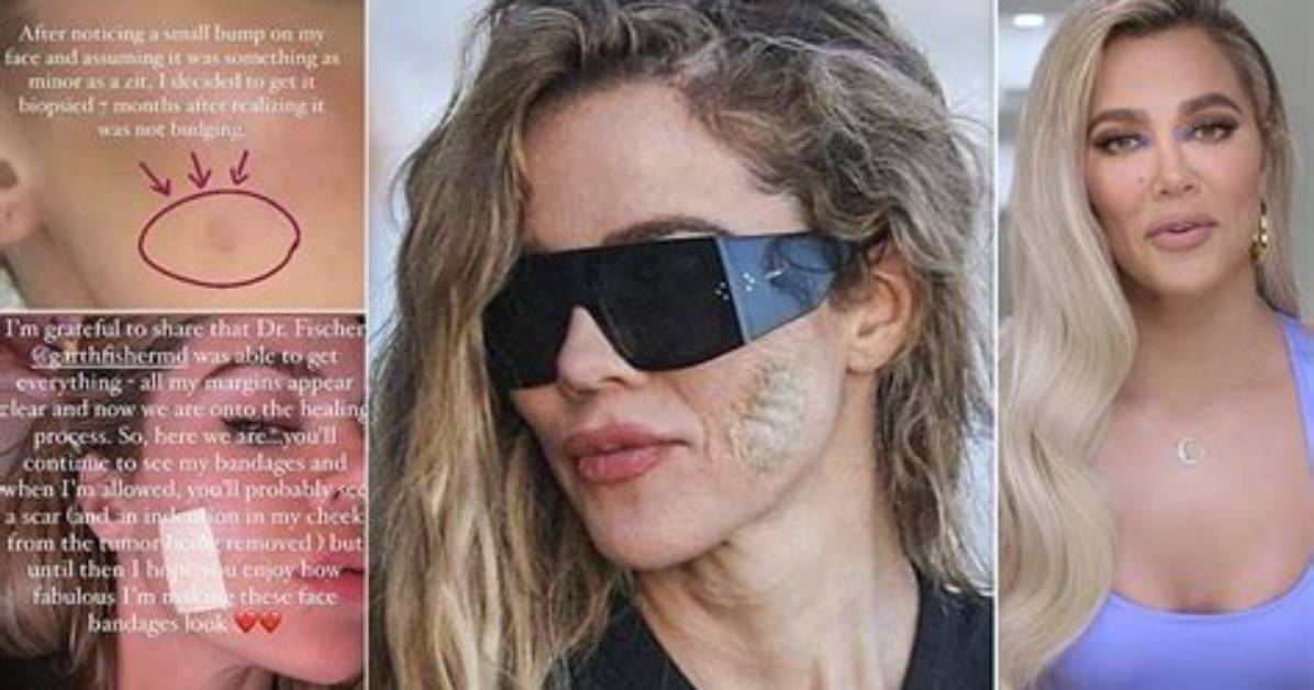 Did Khloe Kardashian Have Skin Cancer?