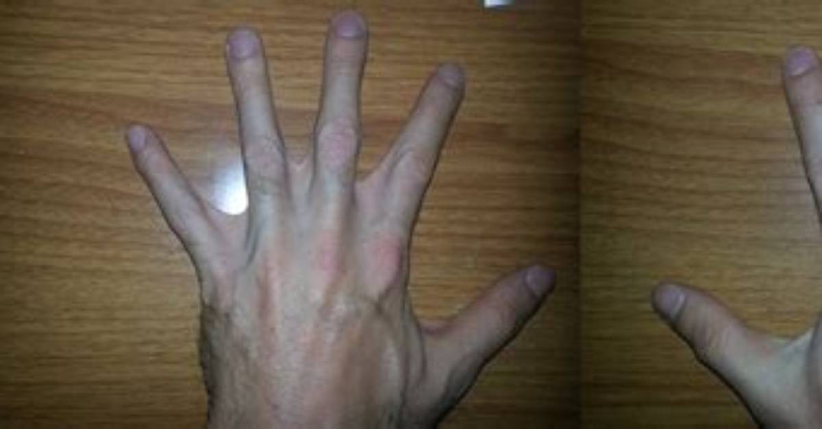 Did Stromberg Have Webbed Hands?
