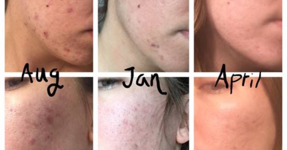 Differin Before or After Moisturizer Reddit