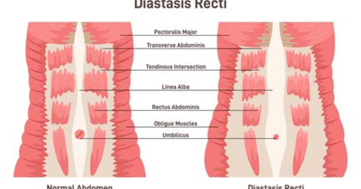 Do Abdominal Binders Help Diastasis Recti?